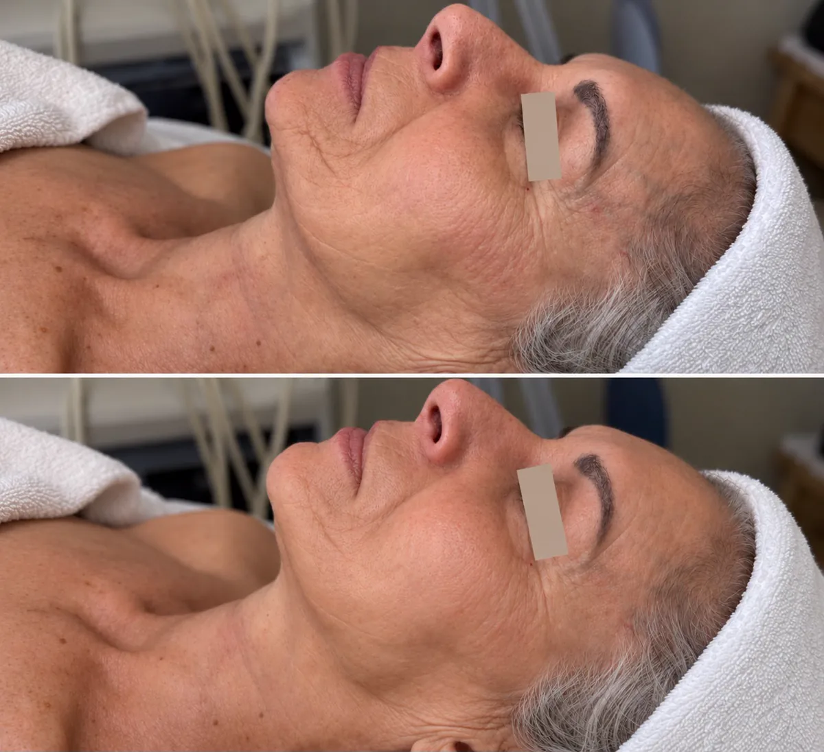 Prima e dopo: viso e collo di una pelle matura seguita da Beauty Life Center
