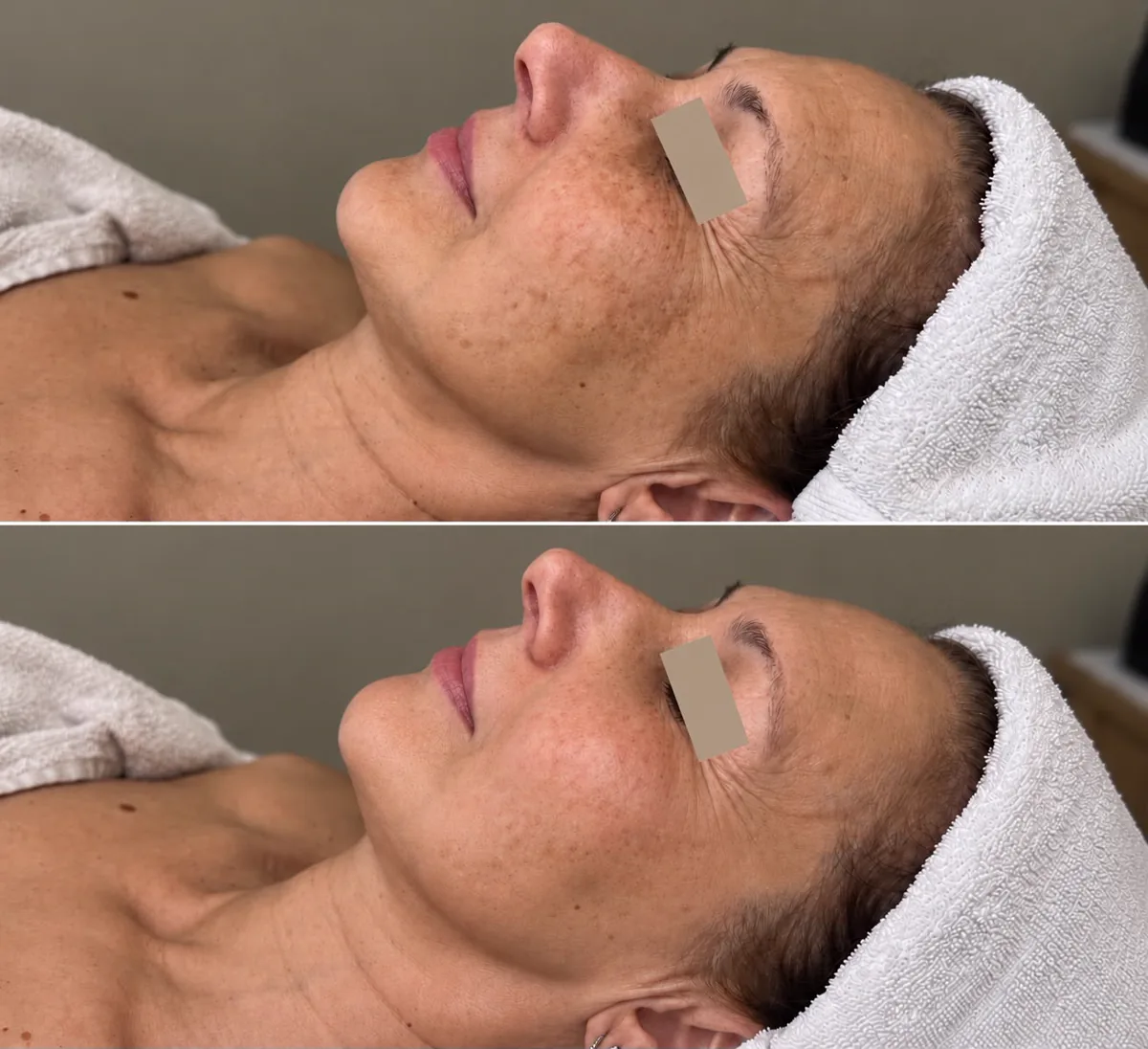 Prima e dopo: macchie e pigmentazione del viso, percorso Beauty Life Center