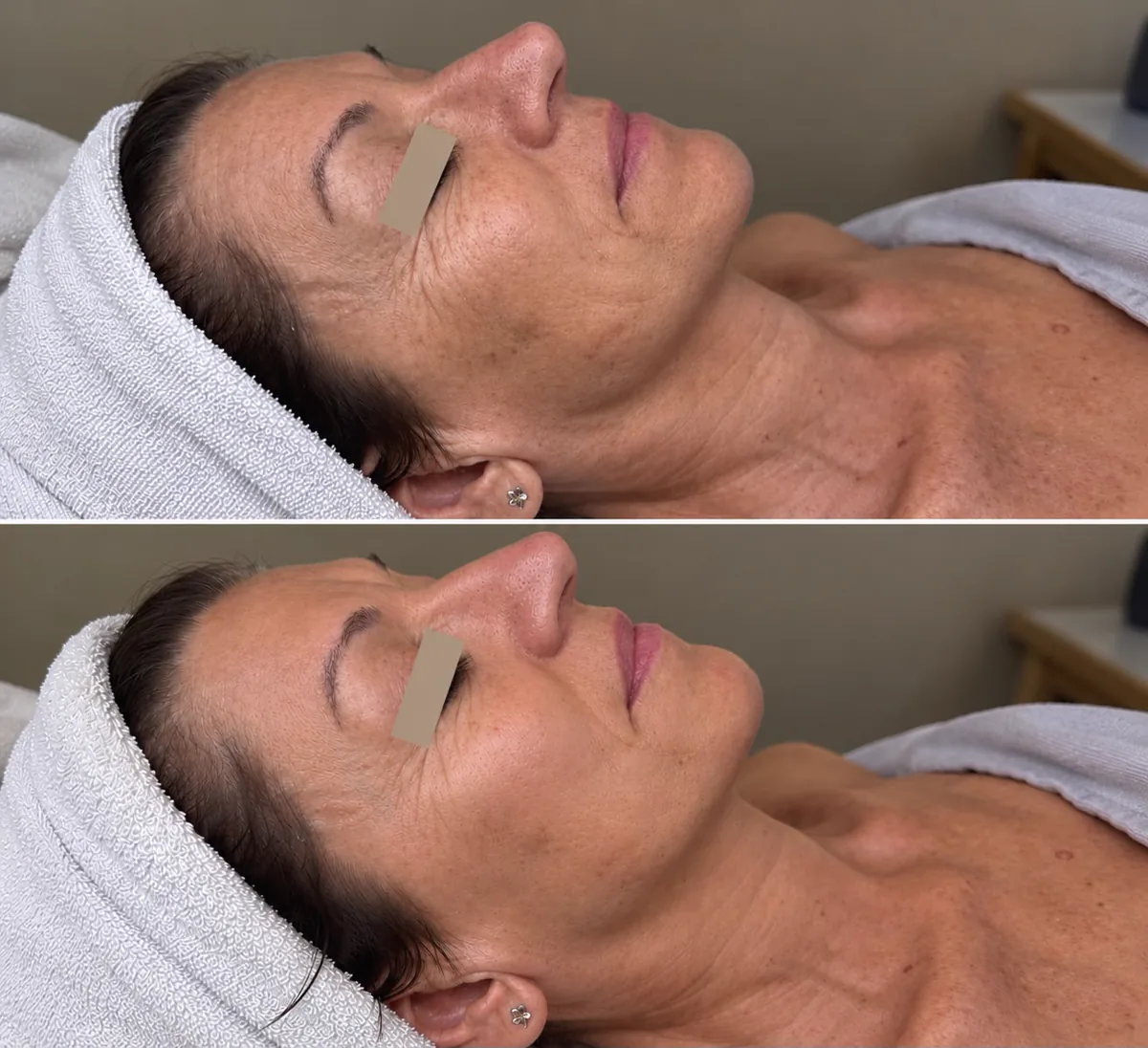 Prima e dopo: rughe e grana della pelle, percorso Beauty Life Center