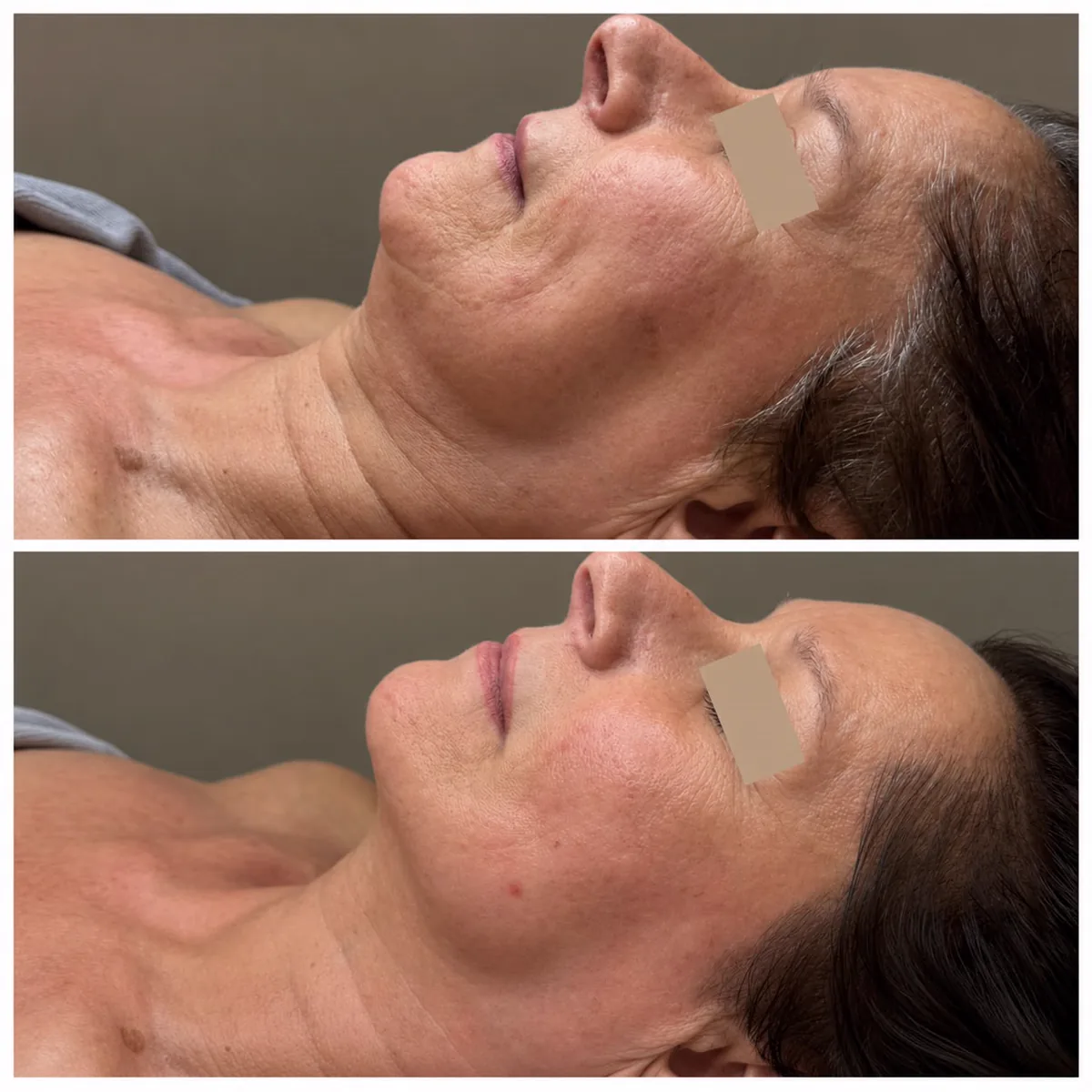 Prima e dopo: tono della pelle e ovale del viso, percorso Beauty Life Center